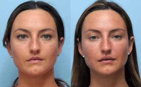 Thread Lift in Dubai: The Ultimate Guide to Non-Surgical Skin Tightening
