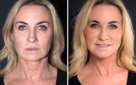 Why the Best Plastic Surgeon in Dubai Prefers Thread Lift for Subtle Facial Rejuvenation