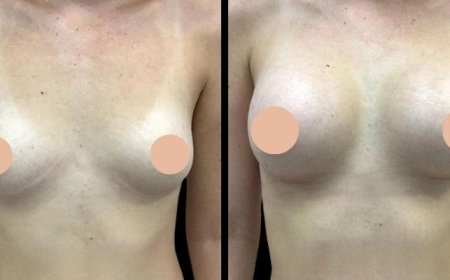 Why the Best Breast Augmentation Surgeons in Dubai Focuses on Tailoring Procedures to Your Unique Body
