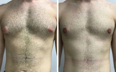 Techniques Preferred by the Best Gynecomastia Surgeons in Dubai