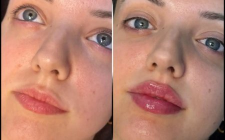 Best Doctors in Dubai for Fillers: Expertise in Facial Aesthetics