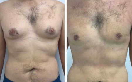 How to Prevent the Return of Gynecomastia in Dubai After Treatment