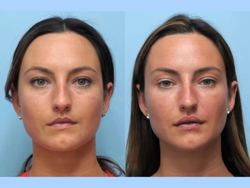 Thread Lift in Dubai: The Ultimate Guide to Non-Surgical Skin Tightening