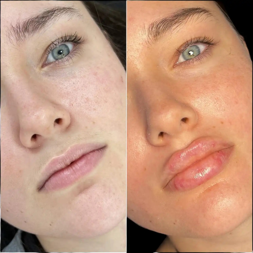 The Secret Behind Radiant Skin: Best Plastic Surgeon in Dubai for Fillers
