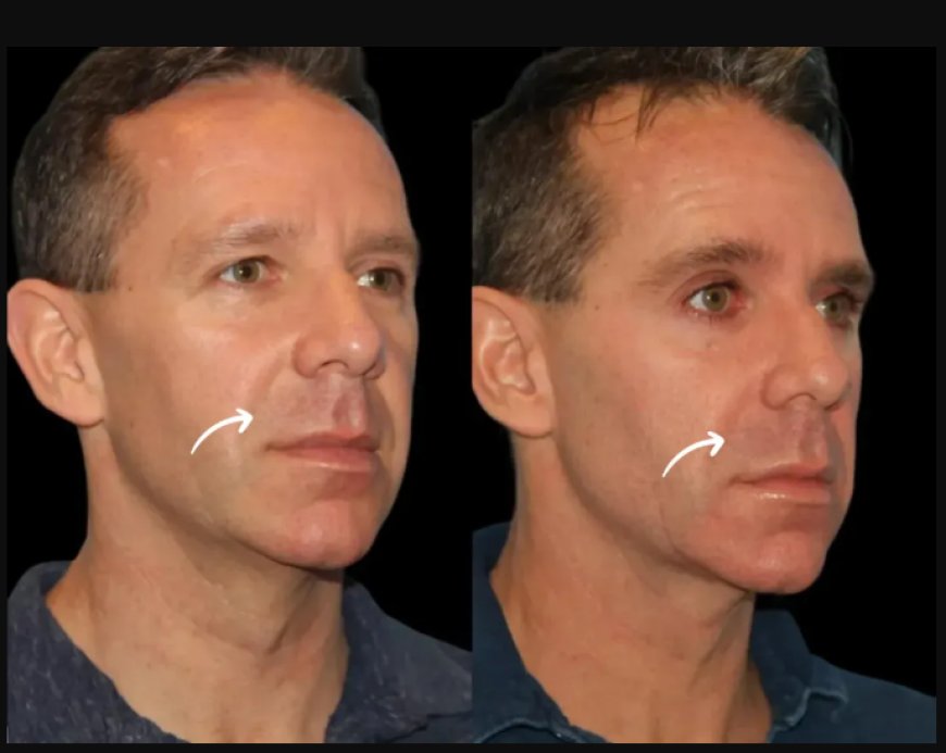 How Sculptra Fillers Work: Explained by Dubai’s Best Plastic Surgeon
