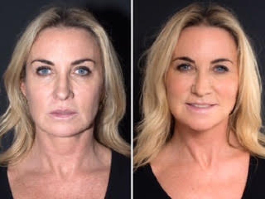 Why the Best Plastic Surgeon in Dubai Prefers Thread Lift for Subtle Facial Rejuvenation