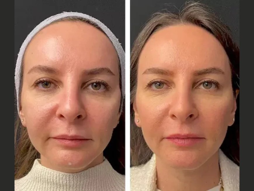 The Best Plastic Surgeon in Dubai on Combining Mesotherapy with Botox or Fillers