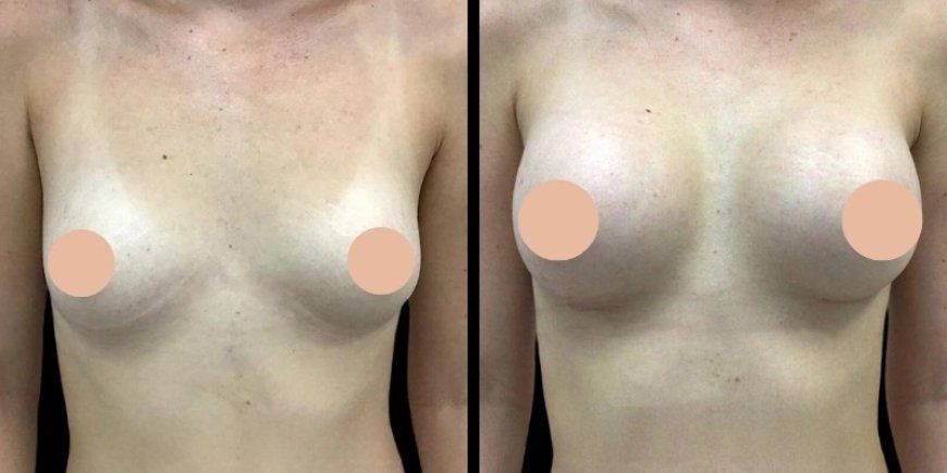 Why the Best Breast Augmentation Surgeons in Dubai Focuses on Tailoring Procedures to Your Unique Body