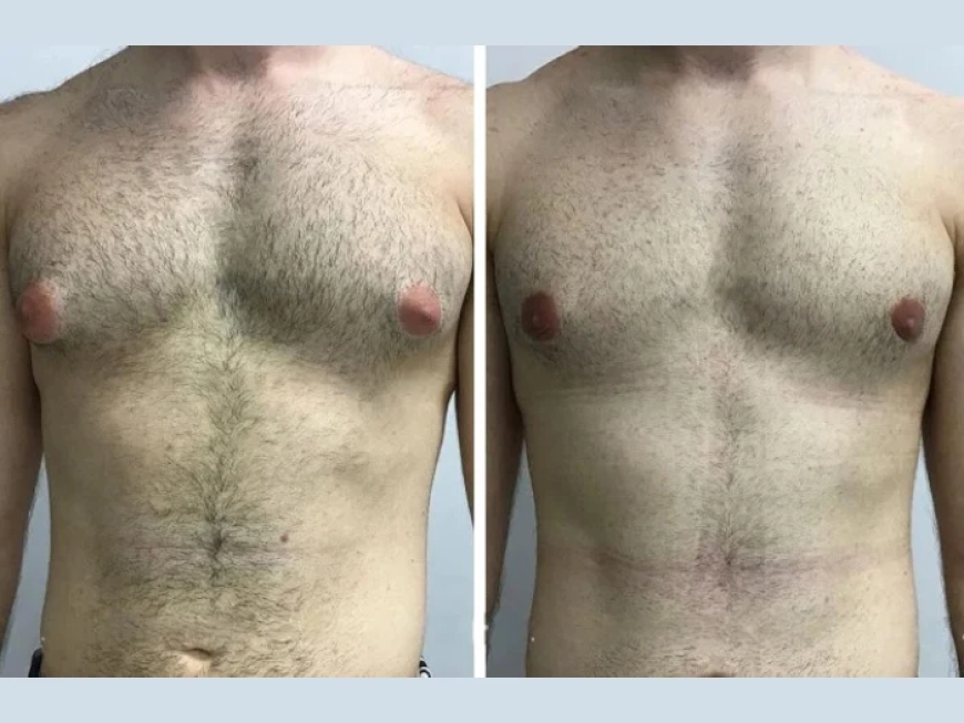 Techniques Preferred by the Best Gynecomastia Surgeons in Dubai