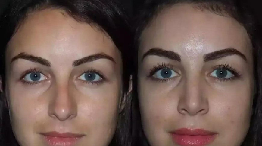 Rhinoplasty in Dubai for Teenagers: What Parents Need to Know