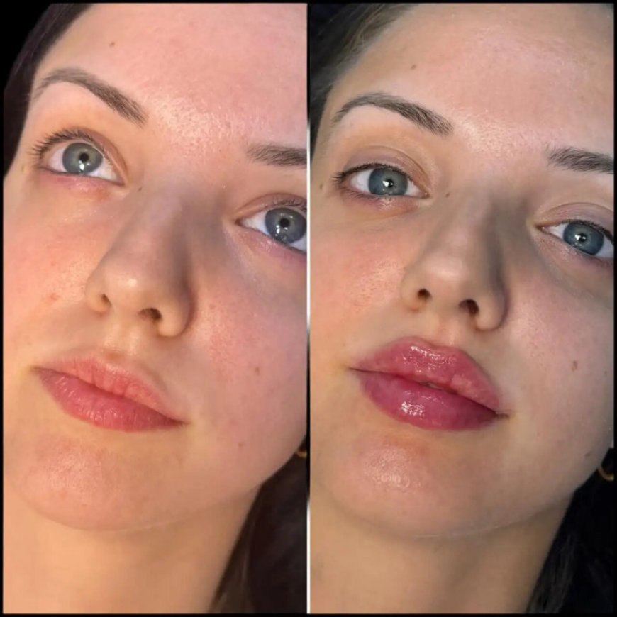 Best Doctors in Dubai for Fillers: Expertise in Facial Aesthetics