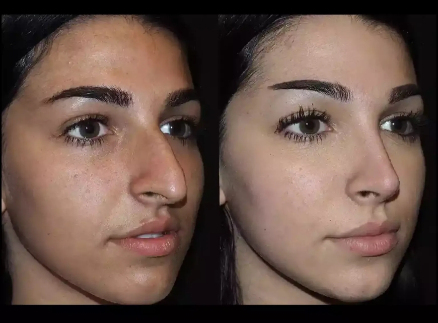 Septoplasty in Dubai: Fixing a Deviated Septum Effectively