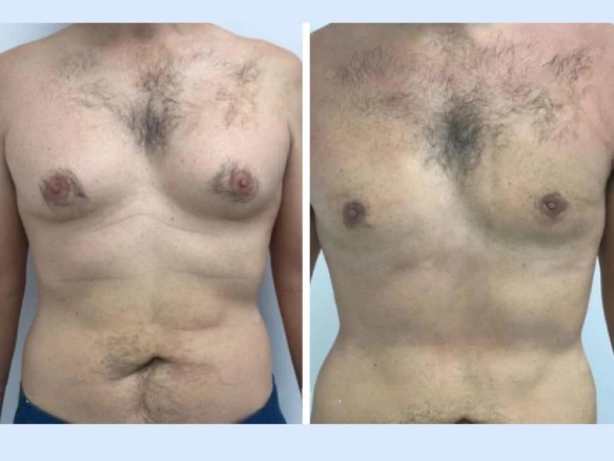 How to Prevent the Return of Gynecomastia in Dubai After Treatment