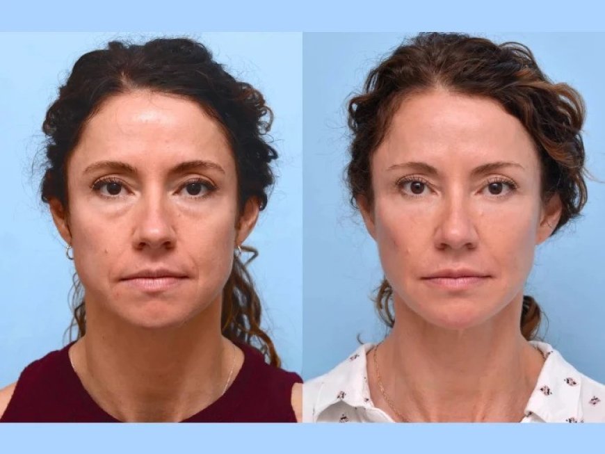 Best Doctors in Dubai for Thread Lift: Can Thread Lifts Be Used on Other Parts of the Body?