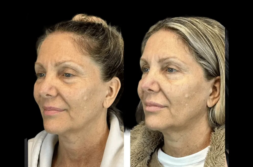 How the Best Doctors in dubai Customize Botox for Different Face Shapes
