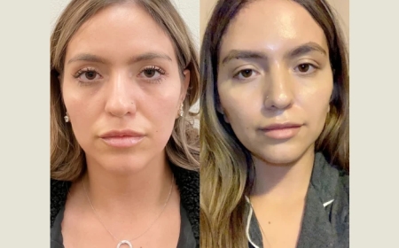 Thread Lift in Dubai: A Guide to Finding the Best Doctors for Long-Lasting Results