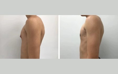 Gynecomastia Surgery in Dubai: Choosing the Best Surgeon for You