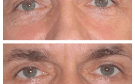 How the Best Eye Bag Removal Surgeon in Dubai Handles Complications