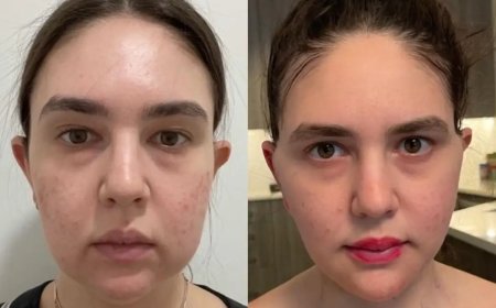 How to Spot a Fake Surgeon: Advice from the Best Buccal Fat Removal Surgeon in Dubai