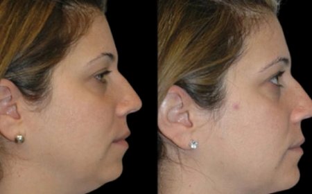 Best Double chin removal Surgeons in Dubai on Skin Types and Healing