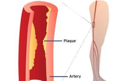 Understanding Peripheral Artery Disease: Causes, Symptoms & Treatment