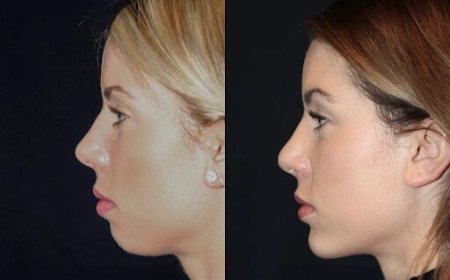 Best Aesthetic Clinics in dubai for Chin Fillers: Comprehensive Aftercare Services