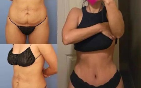 Exploring Dubai’s Unique Approach to Tummy Tuck in Dubai