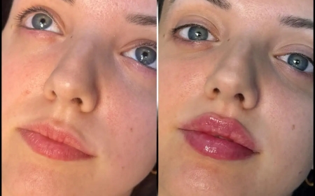 Understanding Fillers from the Best Plastic Surgeons in Dubai