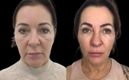 How Profhilo Can Help with Skin Tightening: Tips from the Best Plastic Surgeon in Dubai
