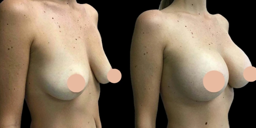 Real Results from Breast Augmentation Surgery in Dubai