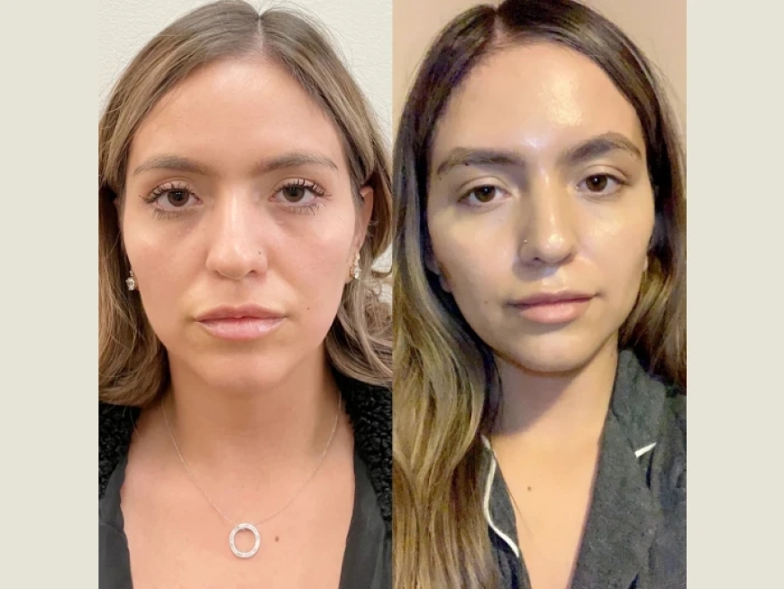 Thread Lift in Dubai: A Guide to Finding the Best Doctors for Long-Lasting Results