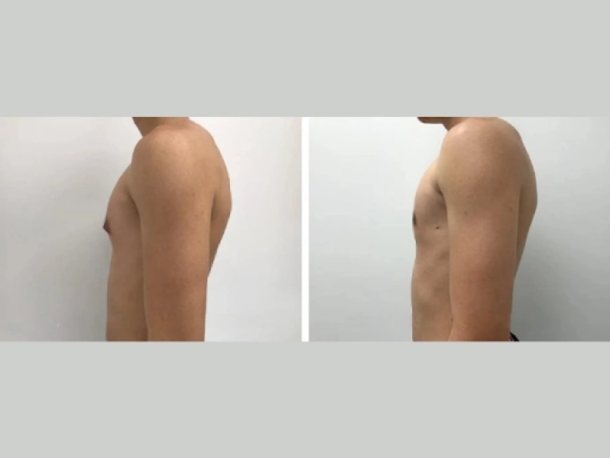 Gynecomastia Surgery in Dubai: Choosing the Best Surgeon for You