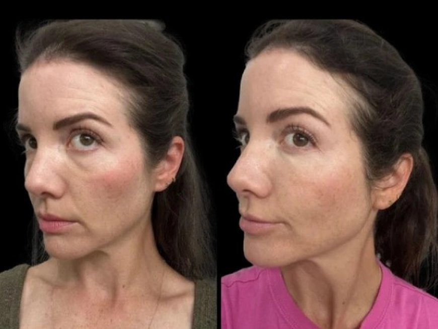 Dark Circles Treatments in Dubai: Cost Comparison of Various Treatment Options