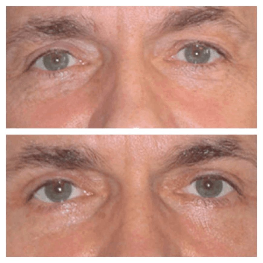 How the Best Eye Bag Removal Surgeon in Dubai Handles Complications