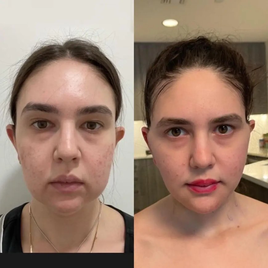 How to Spot a Fake Surgeon: Advice from the Best Buccal Fat Removal Surgeon in Dubai