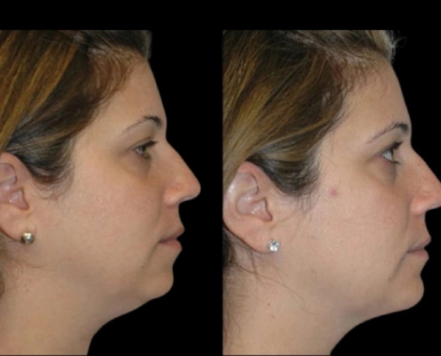 Double Chin Removal for Senior Citizens: A Gentle Approach from the Best Double Chin Removal Surgeon in Dubai