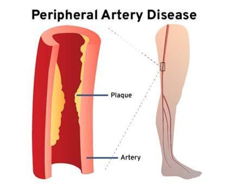 Understanding Peripheral Artery Disease: Causes, Symptoms & Treatment