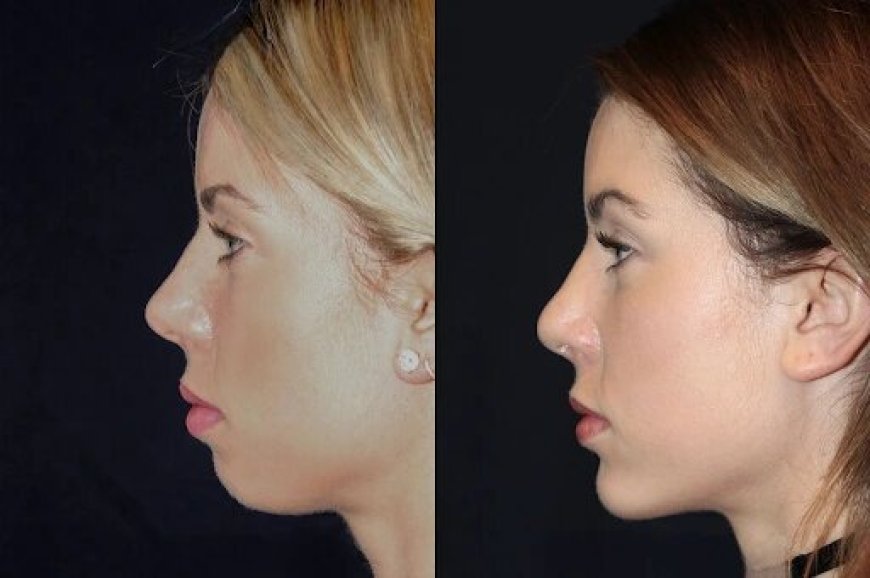 Best Aesthetic Clinics in dubai for Chin Fillers: Comprehensive Aftercare Services