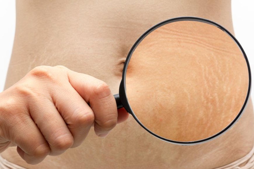 Best Body Butter for Stretch Marks | Fruition Skincare’s Fruit-Infused Moisturizer