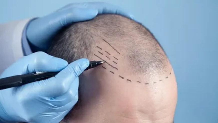 Unlocking Confidence: FUE Hair Transplant in Lahore with Dr Atta Plastic Surgeon