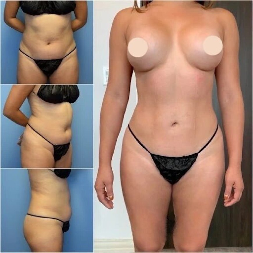 How Body Contouring in Dubai Can Help You Achieve the Hourglass Shape