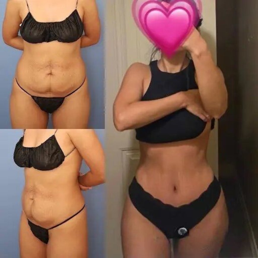 Exploring Dubai’s Unique Approach to Tummy Tuck in Dubai