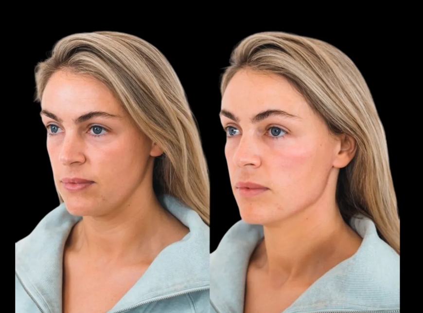 Beautiful Cheek Fillers Are Possible with the Best Plastic Surgeons in Dubai