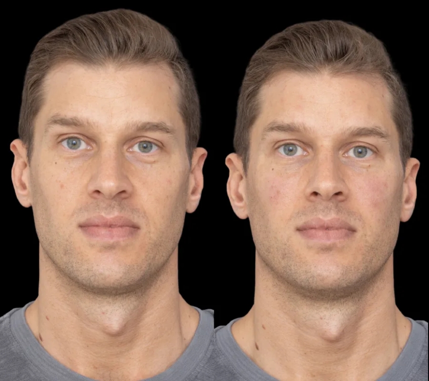 Under Eye Fillers: Trust Only the Best Plastic Surgeons in Dubai