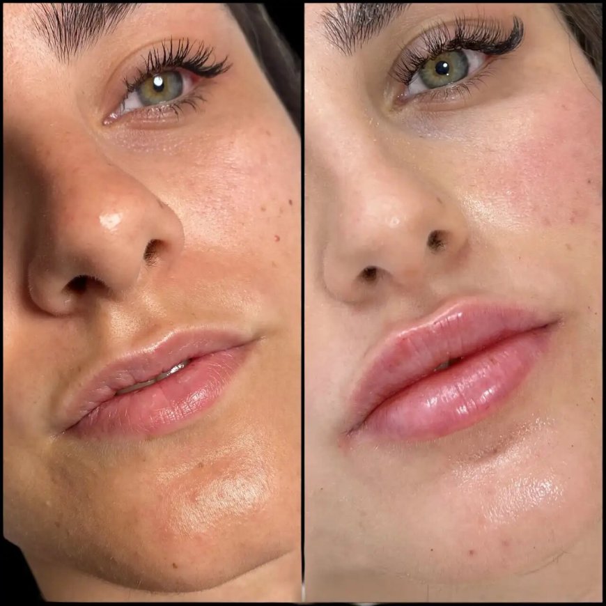 Best Plastic Surgeons in Dubai for Dermal Fillers: Sculpt, Smooth & Enhance Naturally
