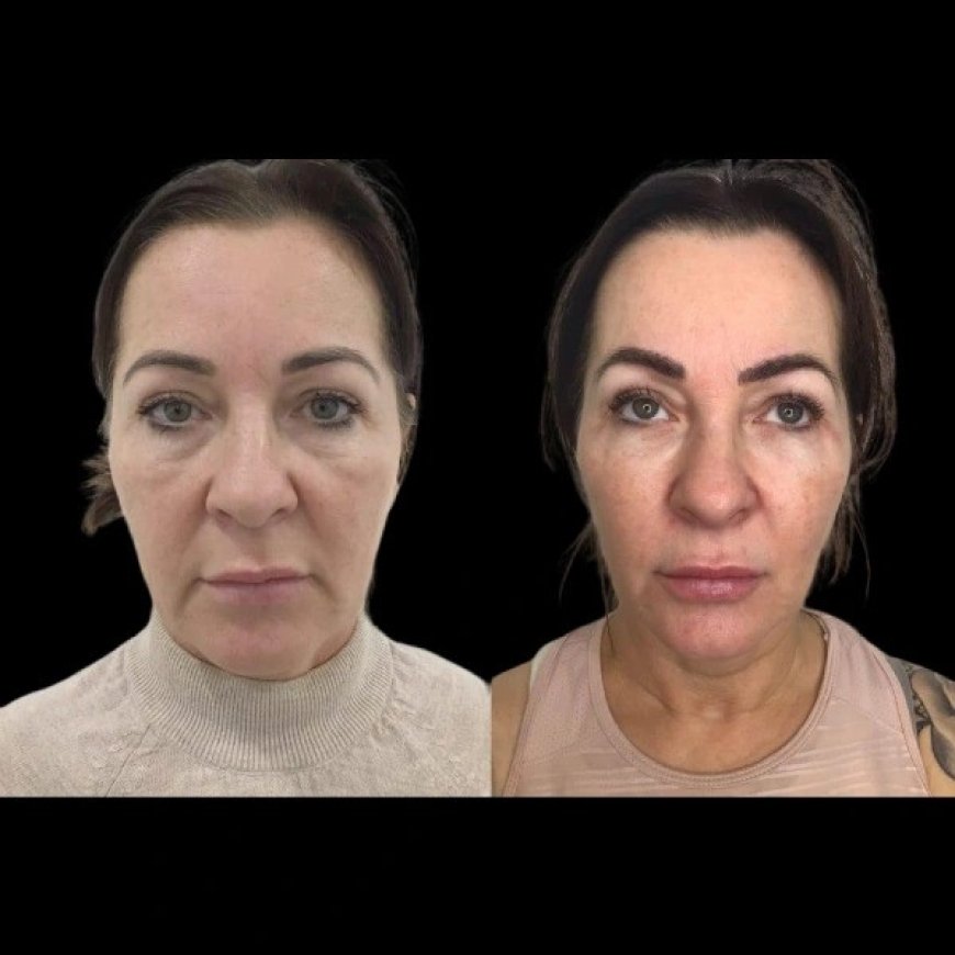 How Profhilo Can Help with Skin Tightening: Tips from the Best Plastic Surgeon in Dubai